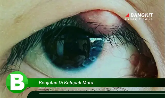 Intip Hal Tentang Benjolan di Kelopak Mata yang Wajib Kamu Ketahui