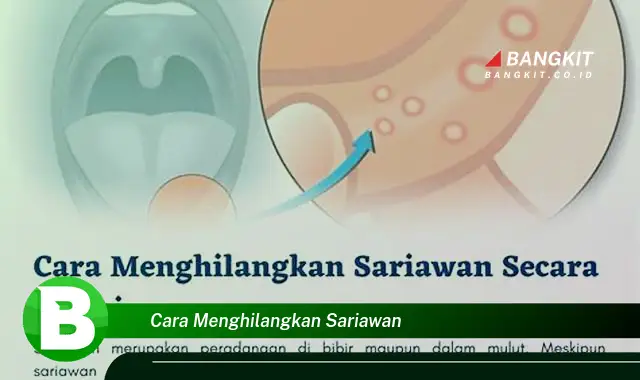 Intip Cara Menghilangkan Sariawan yang Wajib Kamu Ketahui