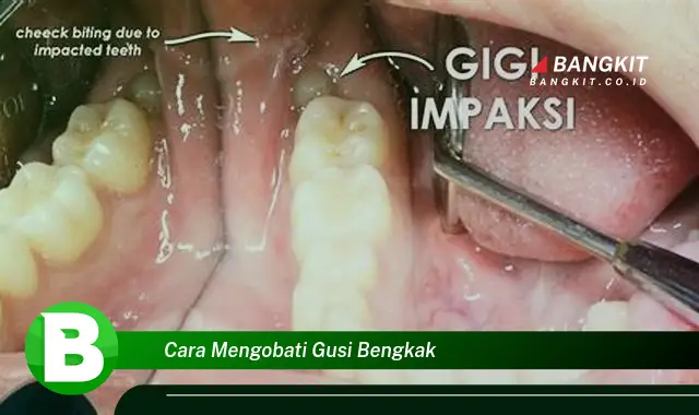 Intip Hal Tentang Cara Mengobati Gusi Bengkak yang Wajib Kamu Intip