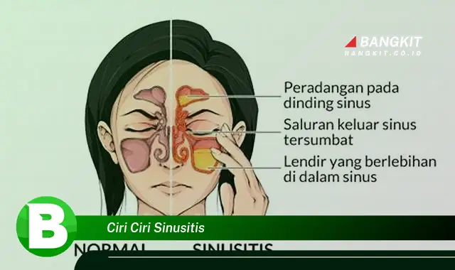 Intip Ciri-Ciri Sinusitis yang Jarang Diketahui