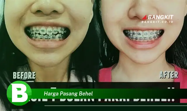 Intip Harga Pasang Behel yang Wajib Kamu Tahu!