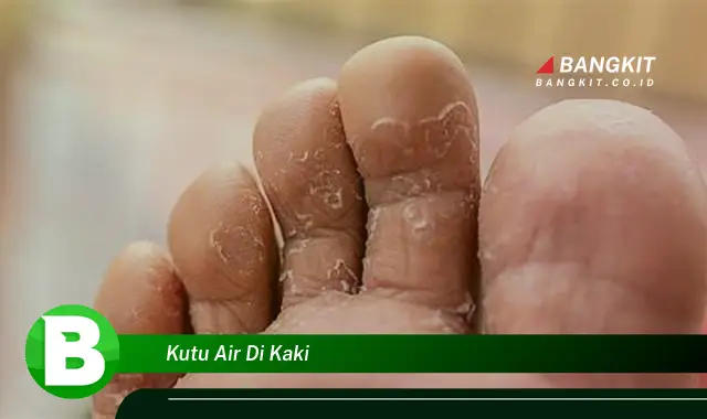 Intip Hal Tentang Kutu Air di Kaki yang Bikin Kamu Penasaran