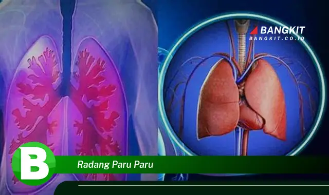 Intip Hal Seputar Radang Paru Paru yang Wajib Kamu Ketahui