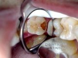 Atasi Sakit Gigi Berlubang – Sudah Pernah Pakai Kantung Teh Atasi Sakit Gigi Berlubang – Sudah Pernah Pakai Kantung Teh