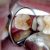 Atasi Sakit Gigi Berlubang – Sudah Pernah Pakai Kantung Teh