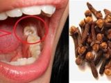 Obat Tradisional Sakit Gigi Terbukti Ampuh Obat Tradisional Sakit Gigi Terbukti Ampuh